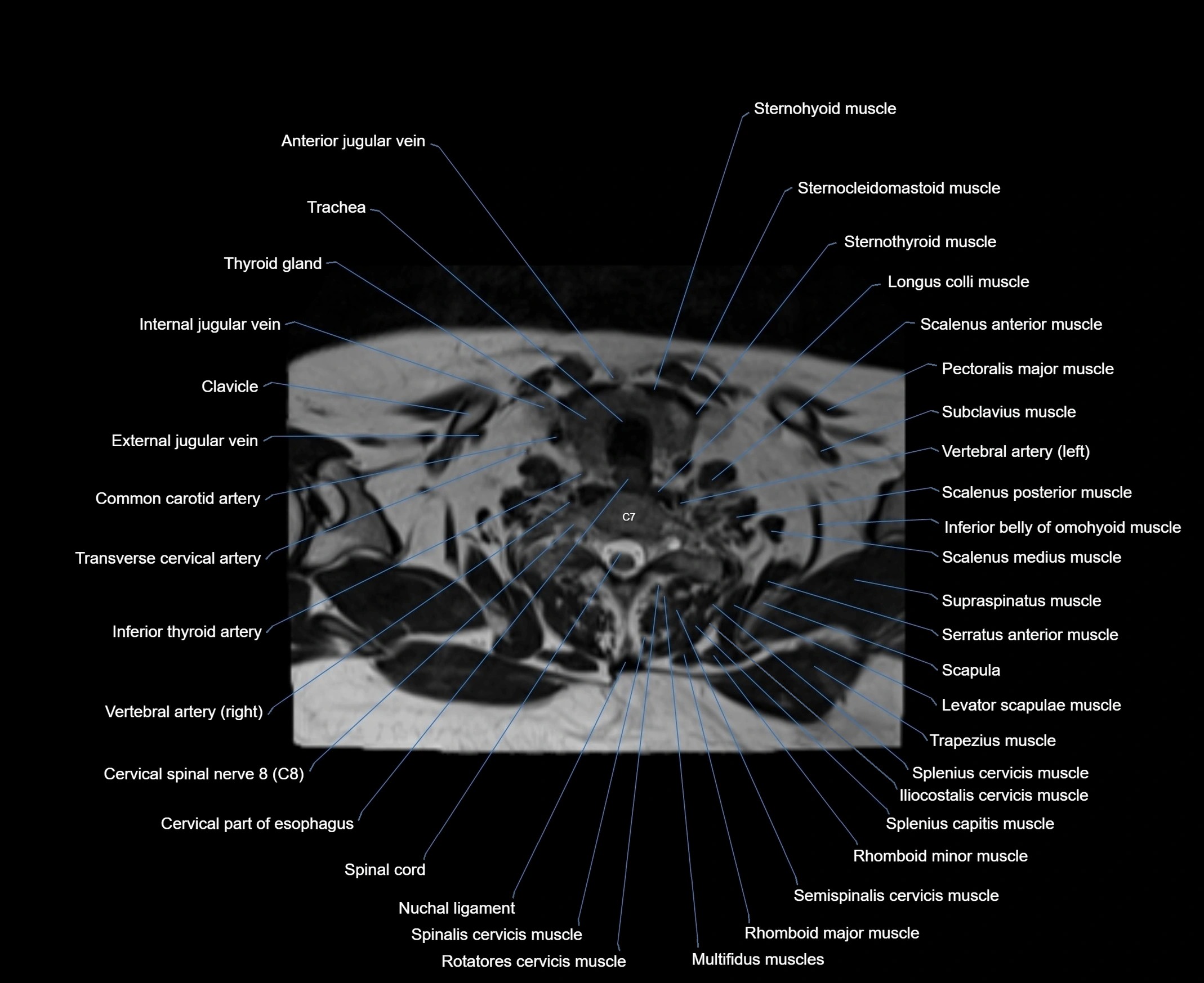 MRI Neck 3D labelled cross section anatomy axial 3t image-00001-00078.webp